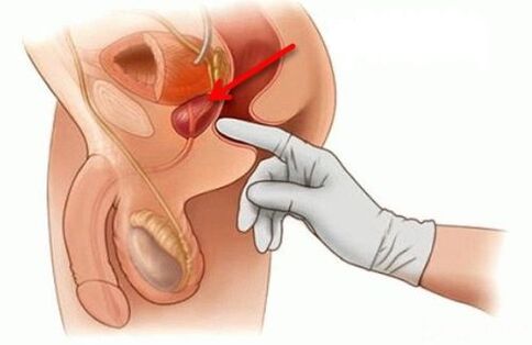 massagem de próstata para prostatite